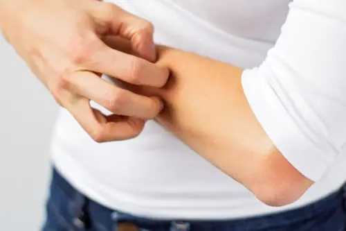 L'allergia alla luce solare